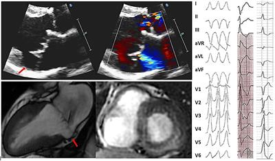 Arrhythmias in Patients With Valvular Heart Disease: Gaps in Knowledge and the Way Forward